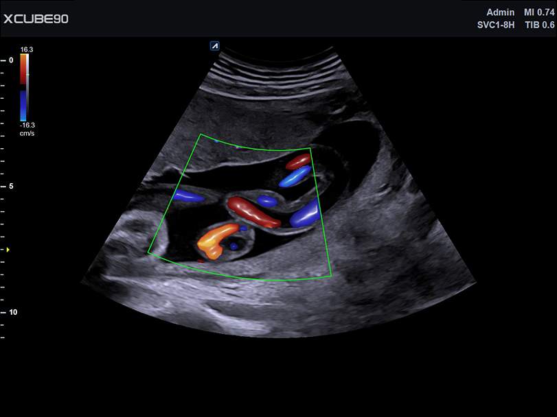 Fetus cord brilliant flow