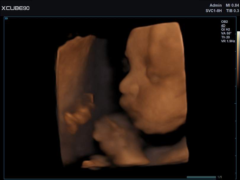 Fetus face with Depth View